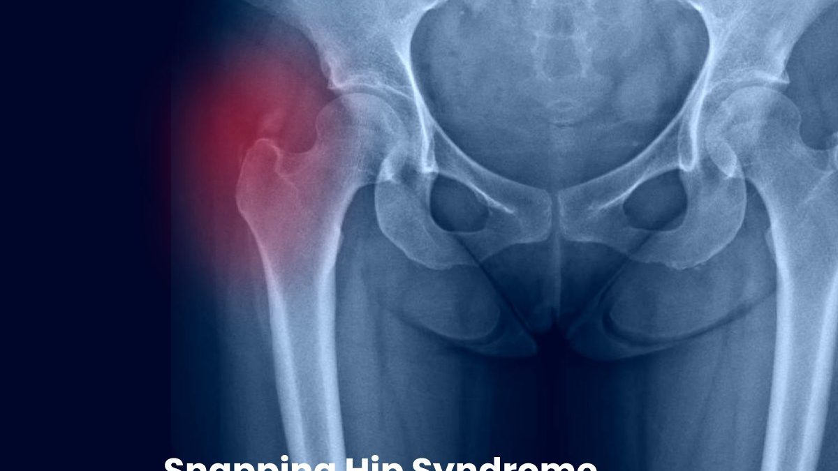 Snapping Hip Syndrome – Classification, Factors, And Treatment