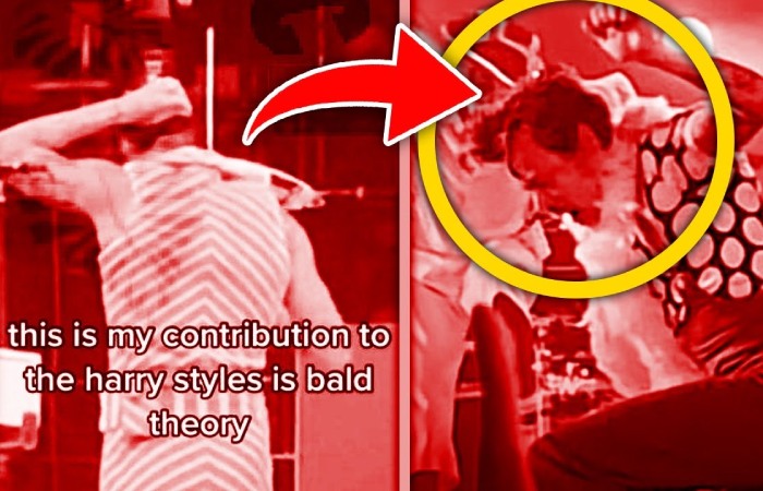 Harry Styles Secretly Bald